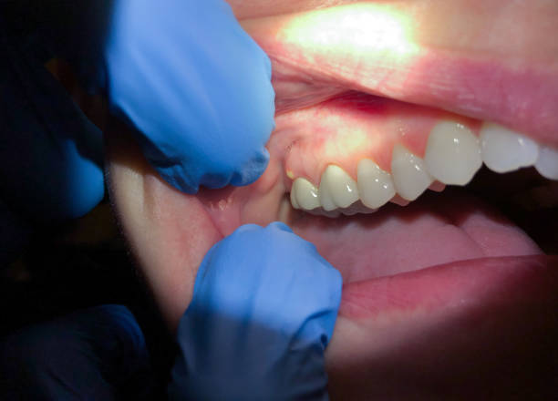 Best Emergency Dentist for Knocked-Out Tooth in Funny River, AK